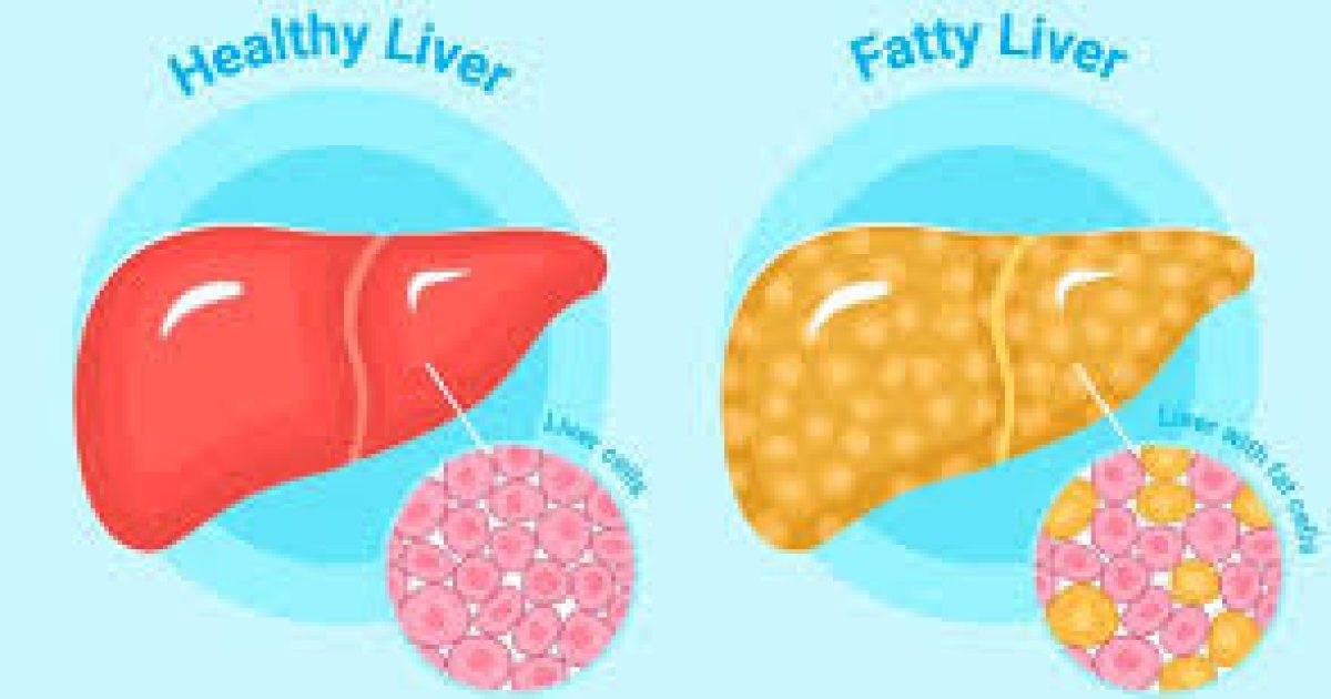 Fatty Liver